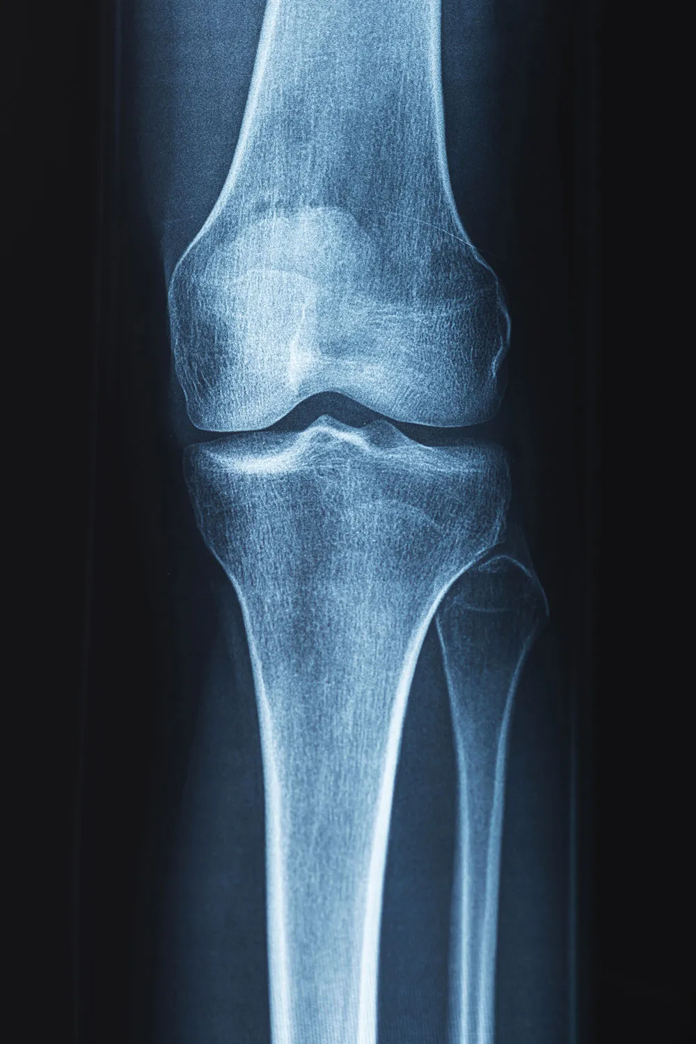 x ray of human knee problems with bone or joint 2023 11 27 05 11 46 utc